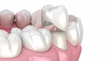 Same-Day Crowns in Foley, AL | Riviera Dental Care