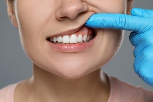 Gum Disease Treatment in Foley, AL | Riviera Dental Care
