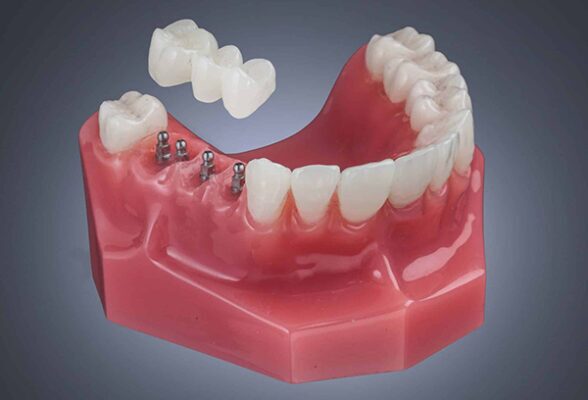Dental Implants in Orange Beach | Mini Dental Implants
