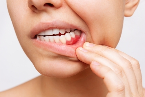 Urgent Dental Care in Foley, AL | Providing Gum Disease Treatment