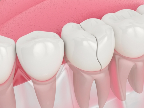 Urgent Dental Care in Foley, AL | Providing Comfort and Pain Relief