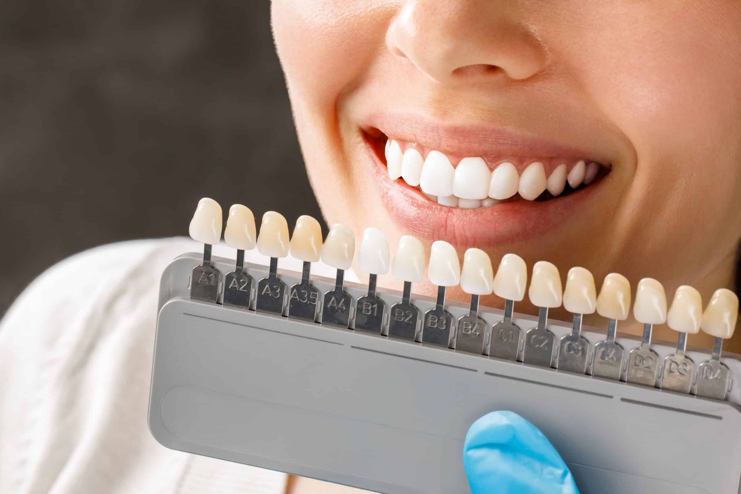 Porcelain Veneers in Foley, Alabama