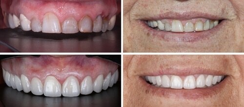 Dental Veneers in Foley, AL | Riviera Dental Care