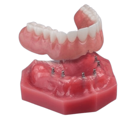 Dentures in Foley, AL | Same-Day Services and Implant Dentures