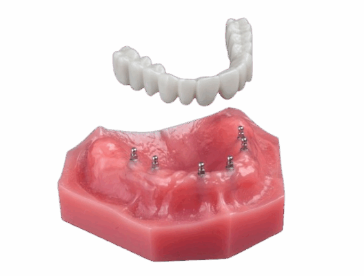 Teeth In A Day in Foley, AL | Book a Free Implant Consultation!