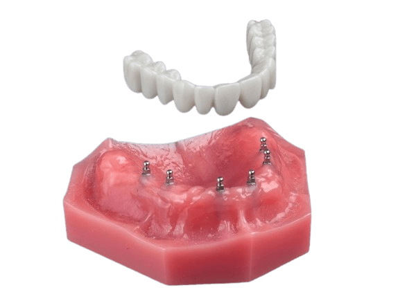 Teeth In A Day in Foley, AL | Book a Free Implant Consultation!