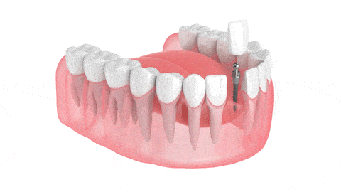 Mini Dental Implants in Foley, AL | Riviera Dental Care