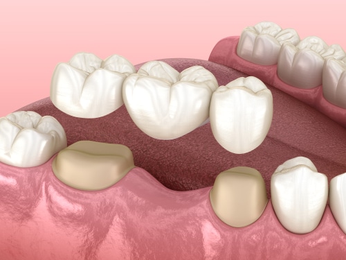 Dental Bridge in Foley, AL | Riviera Dental Care