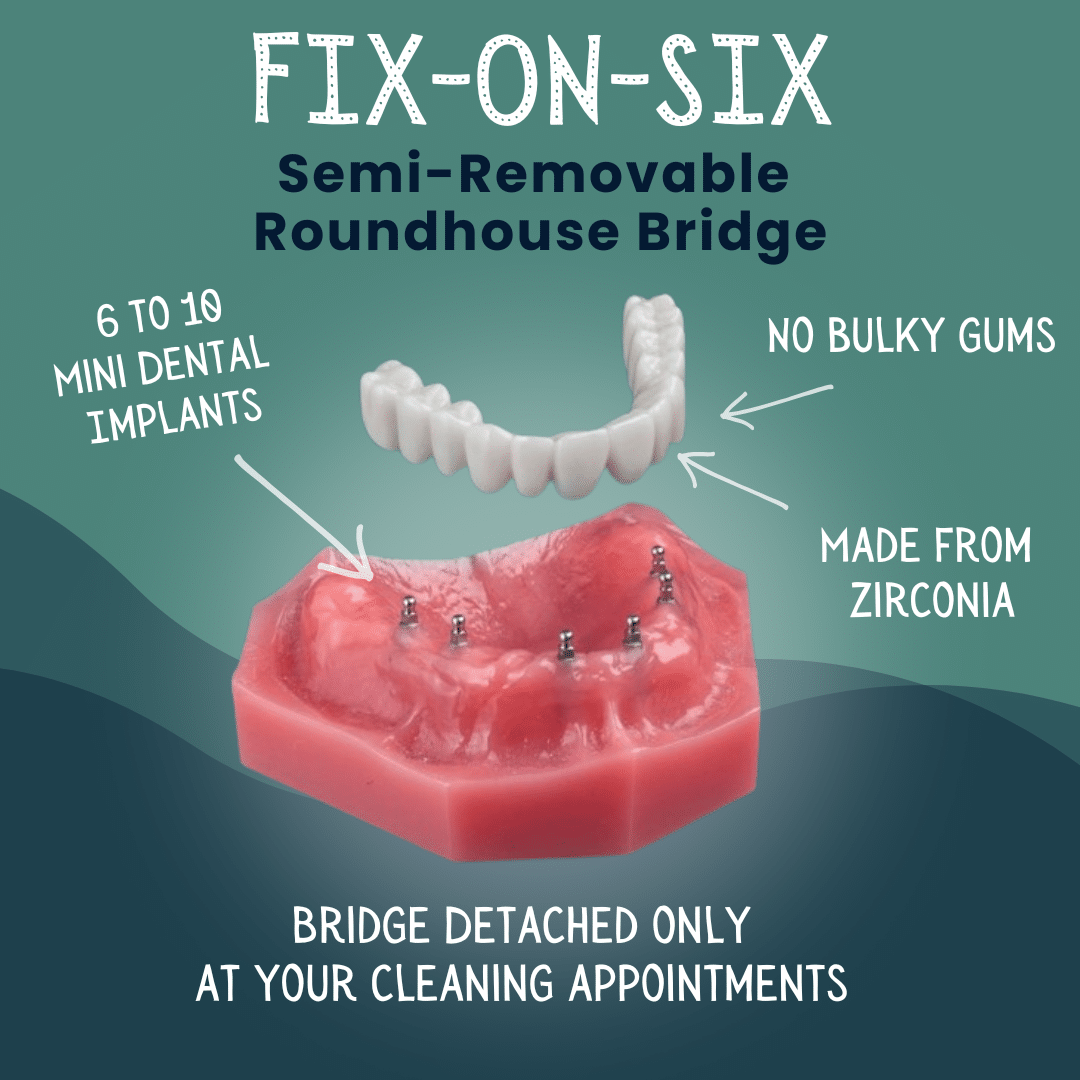 Fix-On-Six - All on 4 Alternative in Foley, AL - Riviera Dental Care