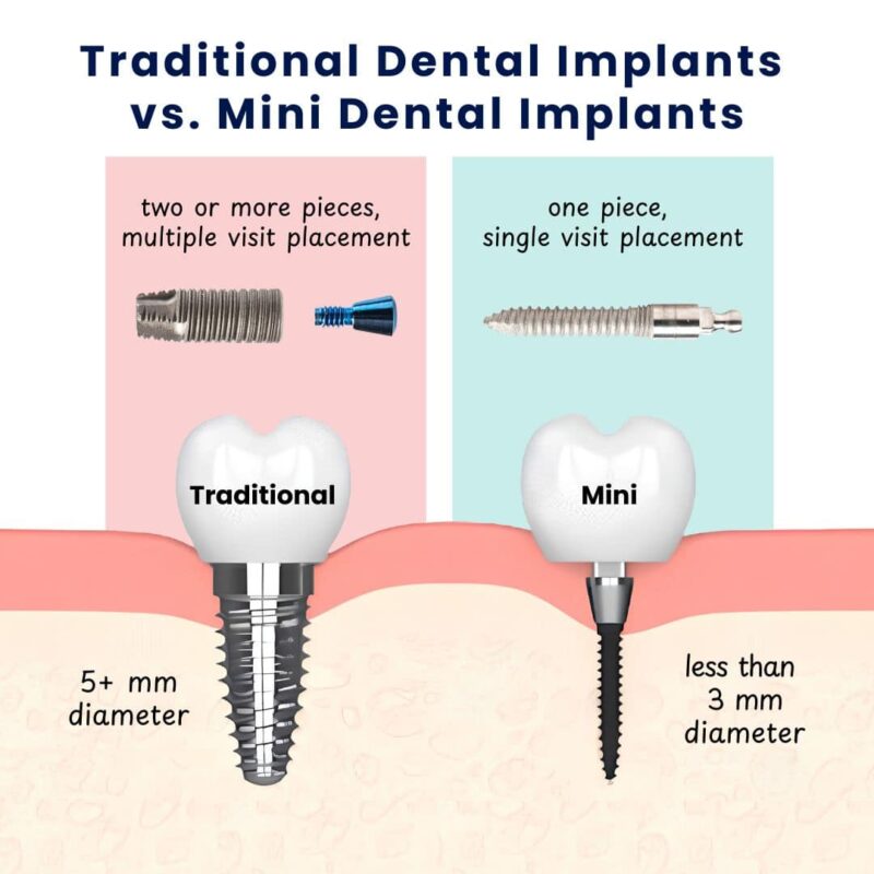Mini-Dental-Implants-vs.-Conventional-Dental-Implants