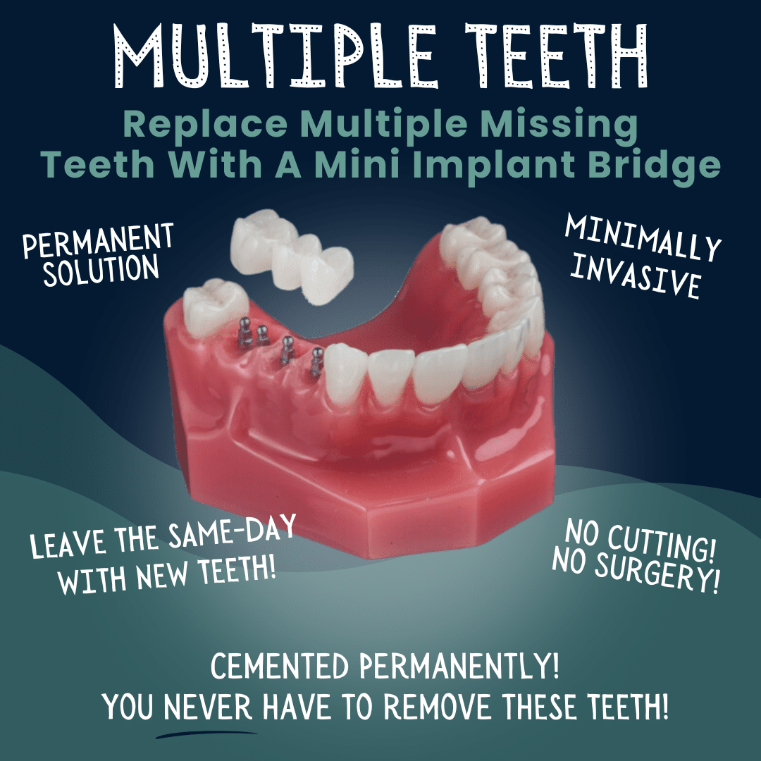 Multiple Tooth Replacement in Foley, AL - Riviera Dental Care