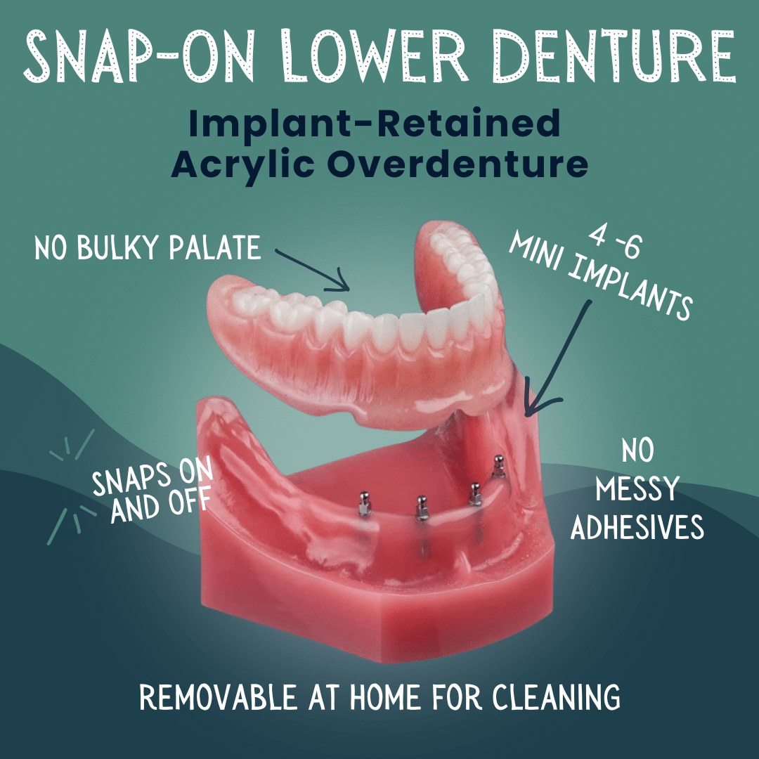 Snap on Lower Denture in Foley, AL - Riviera Dental Care