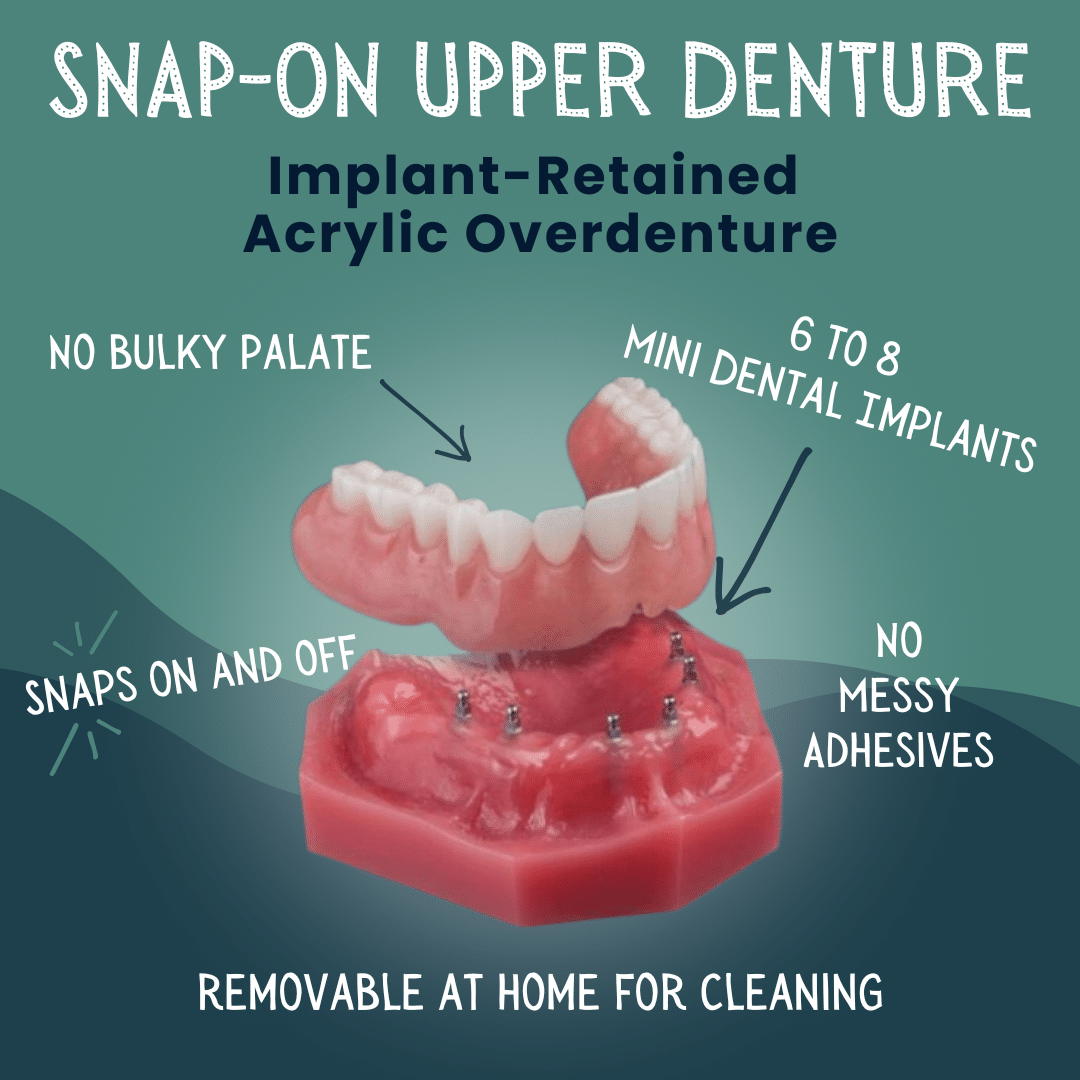 Snap on Upper Denture in Foley, AL - Riviera Dental Care