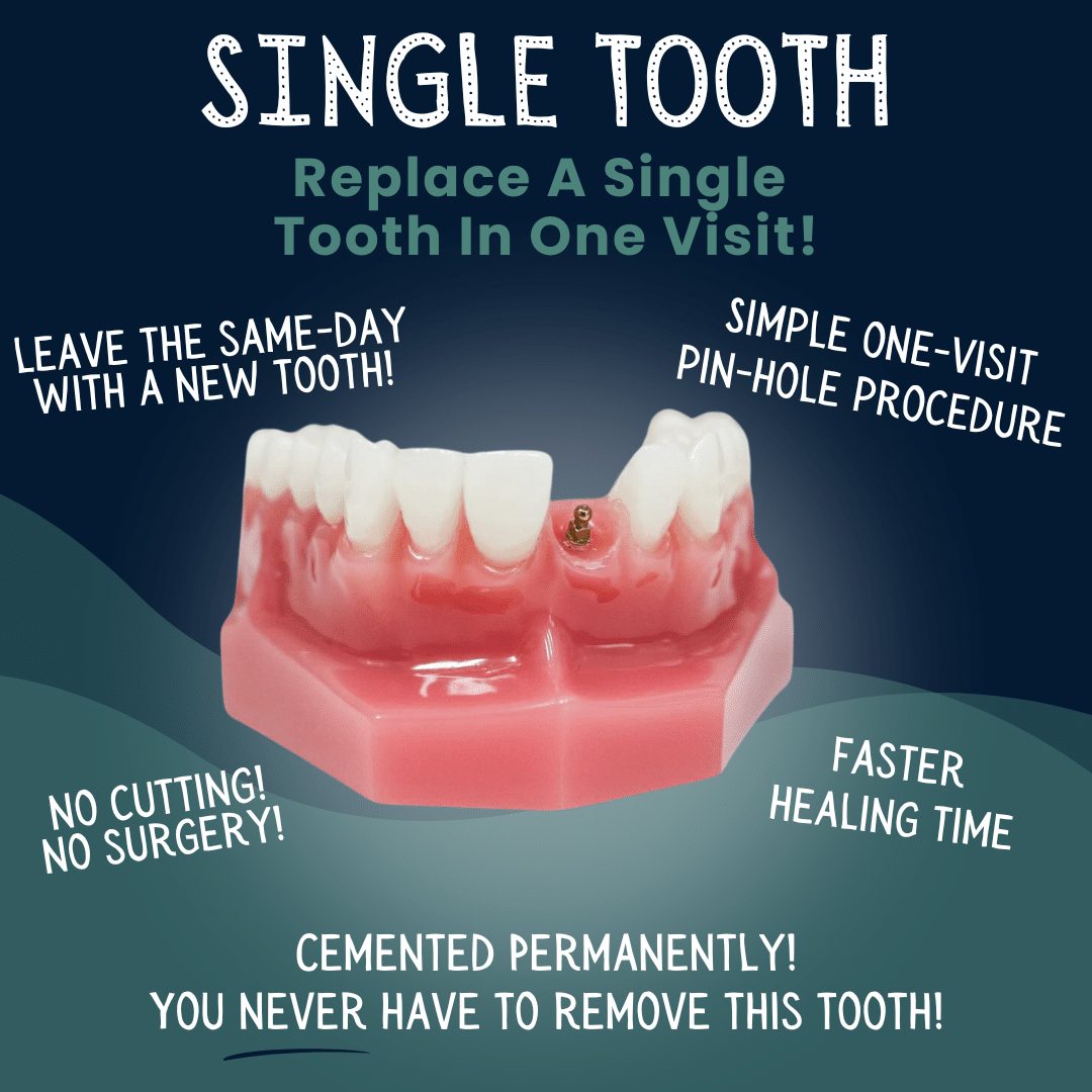 Tooth Replacement in Foley, AL - Riviera Dental Care