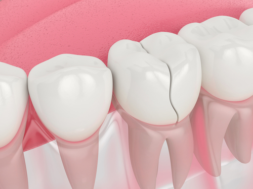 Urgent Dental Care in Foley, AL | Providing Comfort and Pain Relief