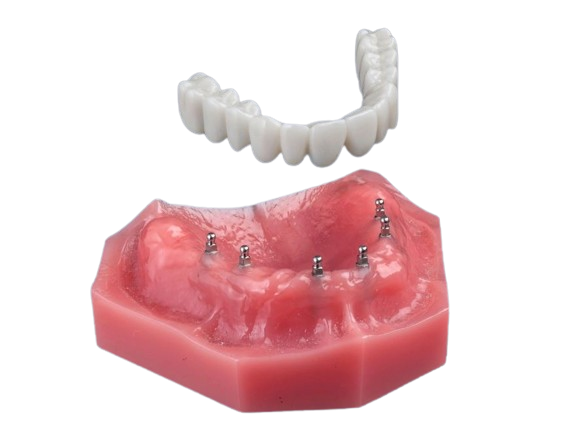 Teeth In A Day in Foley, AL | Book a Free Implant Consultation!