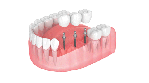 Foley Implant Dentist | Free Consultations | Dental Bridge Restorations