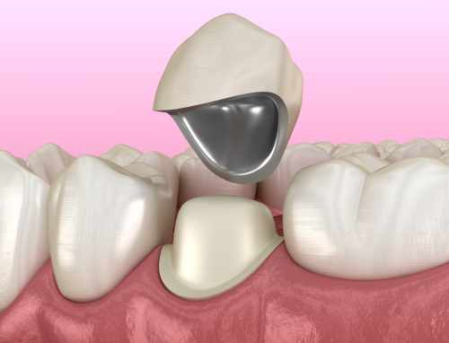 Emergency Dentist in Foley, AL | Restore Your Broken Teeth