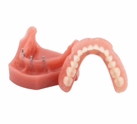 Snap-In Dentures in Foley, AL | Book a Free Implant Consultation
