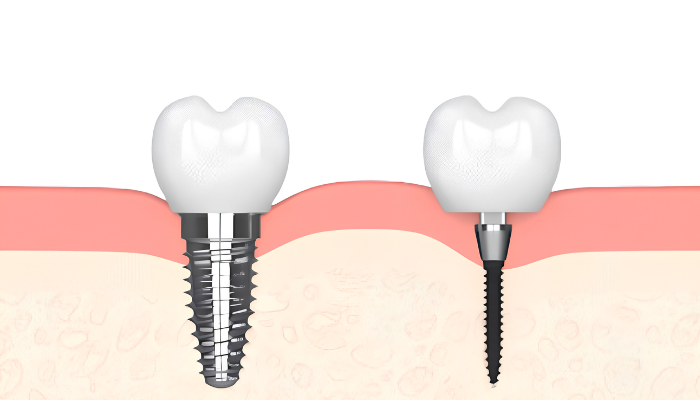 What Is the Difference Between a Mini Implant and a Conventional Implant? | Free Consultations in Foley, AL