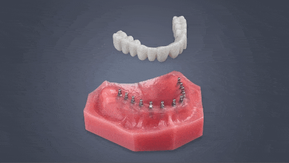 Full-Arch Dental Implants in Foley, AL | Restore Your Smile Securely