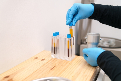 What is L-PRF Treatment Used For? | Accelerate Your Healing in Foley, AL