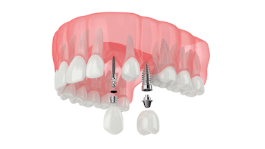 Gulf Shores Implant Dentist | Restore Your Smile With Mini Implants