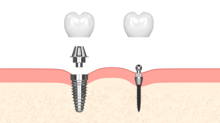 Dental Implants in Elberta, AL [Video Guide] | Free Consultations