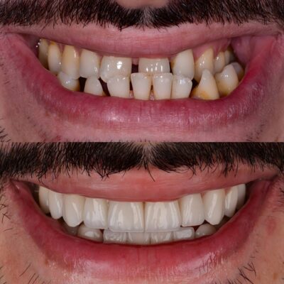 Instant Orthodontics in Foley, AL [Video Walkthrough] | Veneers