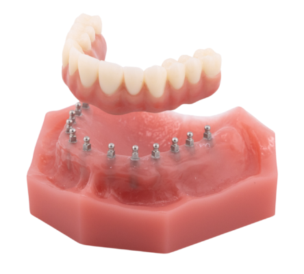 Full Arch Dental Implants [A Video Breakdown] | Free Consultations