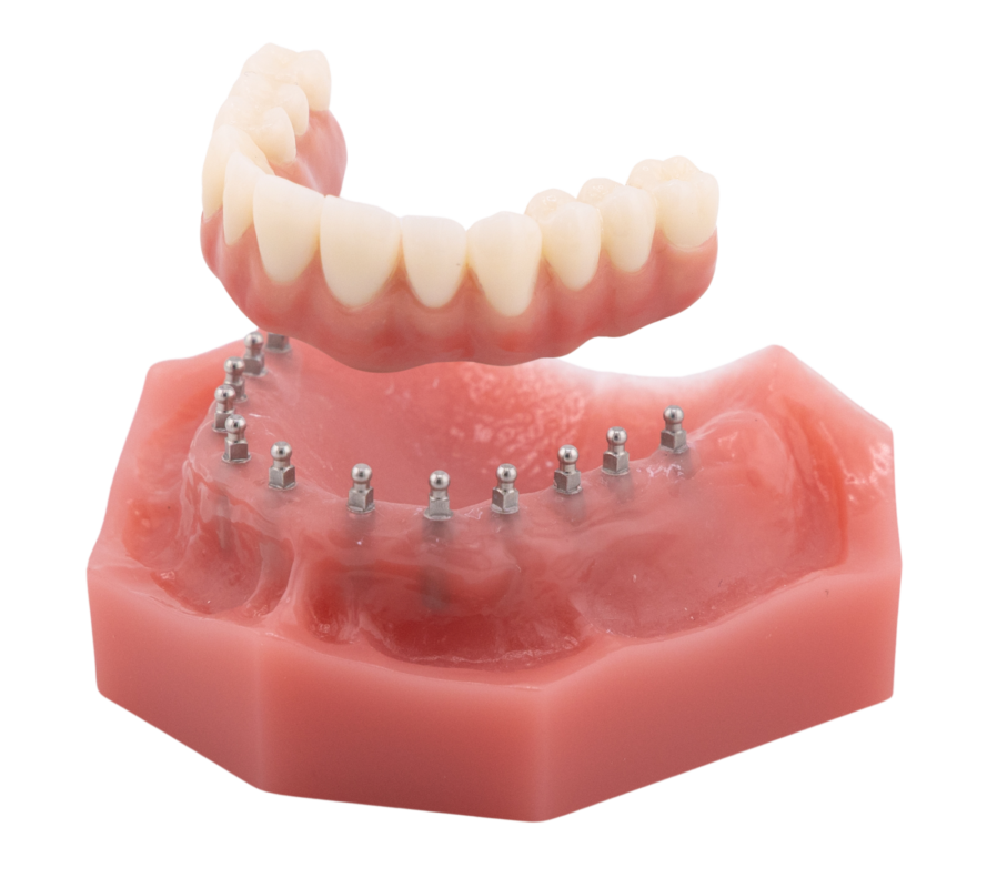 Full Arch Dental Implants [A Video Breakdown] | Free Consultations