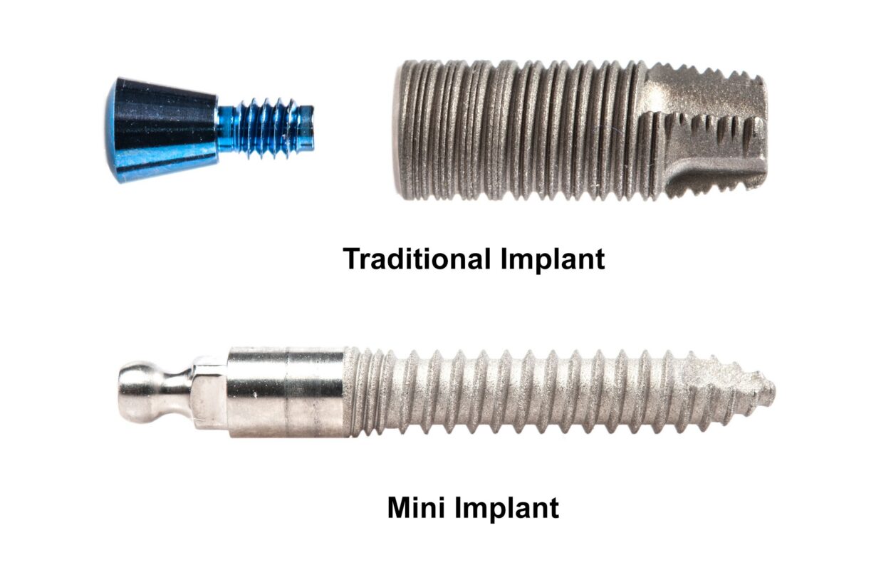 One-Piece Implants [A Video Overview] Free Implant Consultations