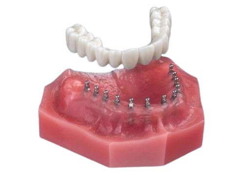 Permanent Dentures [Video Inside] | Free Implant Consultations