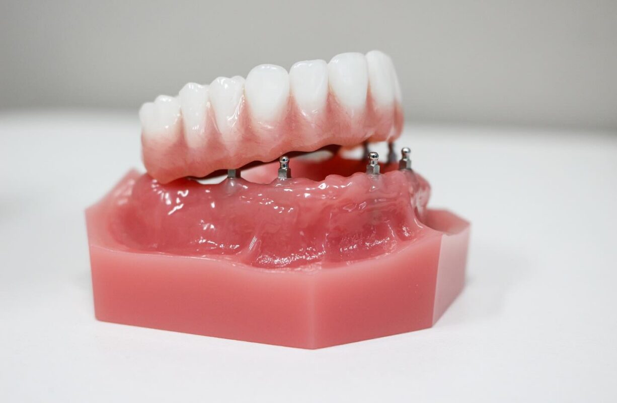 Denture Stabilization [Video Guide] | Free Implant Consultations