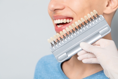 Veneers Cost [Video Explanation] | Redesign Your Smile Affordably