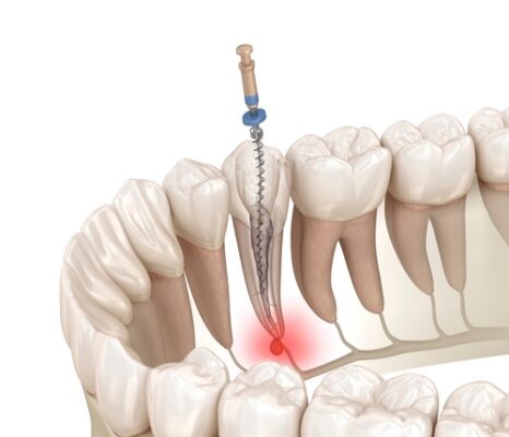 Root Canal Pain Relief [Video Breakdown] | Relieve Tooth Pain