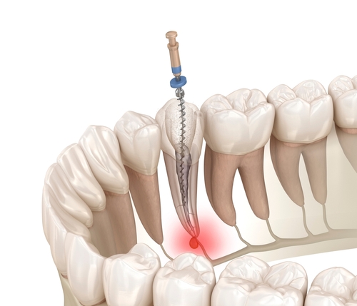 Root Canal Pain Relief [Video Breakdown] | Relieve Tooth Pain