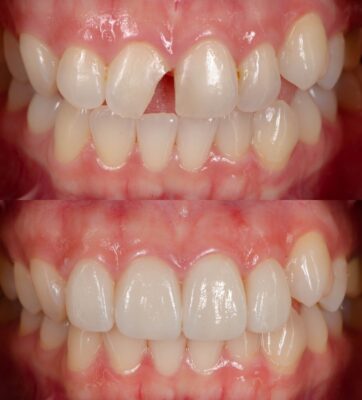 Broken Tooth Repair in Foley, AL | Repair Your Smile