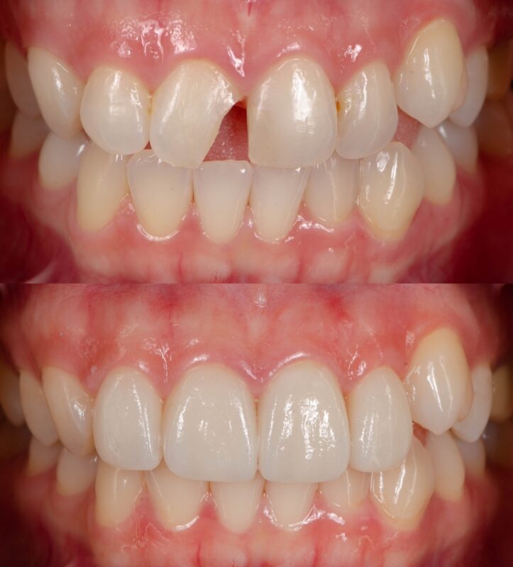 Broken Tooth Repair in Foley, AL | Emergency Dentist Near Me