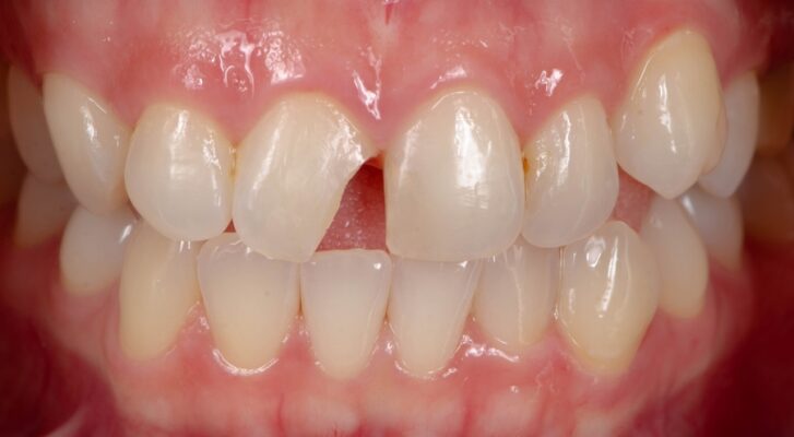 Broken Tooth Repair in Foley, AL | Emergency Dentist Near Me