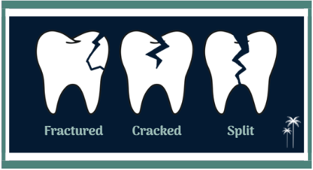 Broken Tooth Repair in Foley, AL | Types of Broken Teeth