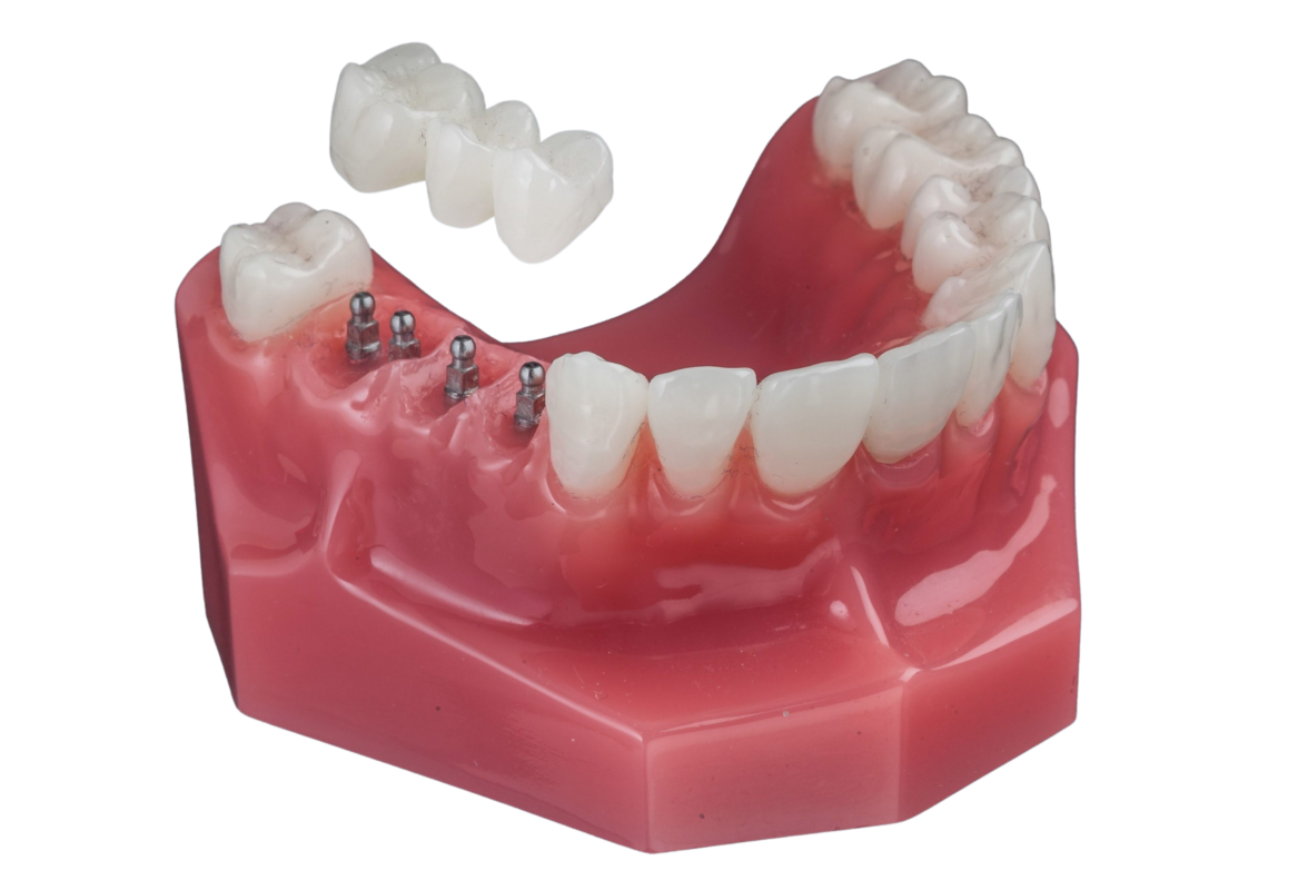Implant Bridge in Foley, AL [Video Inside] Free Implant Consultation