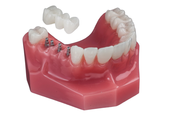 Implant Bridge in Foley, AL [Video Inside] Free Implant Consultation