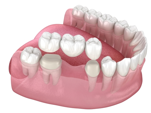 Implant Bridge vs. Traditional Bridge | Book a Free Implant Consultation in Foley, AL [Video Inside] 