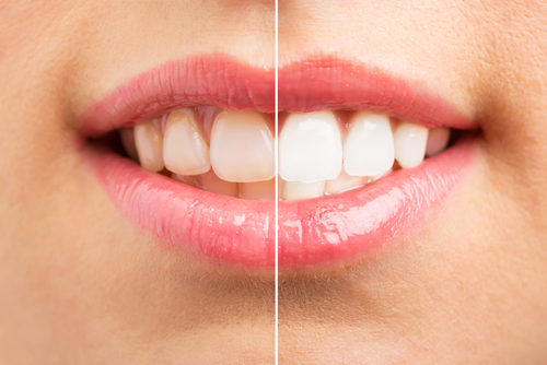 Best Teeth Whitening in Foley, AL | Brighten Your Smile in One Visit